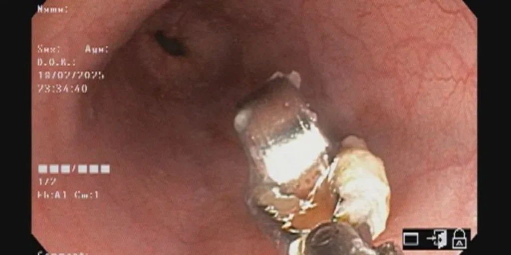 A real-life case of emergency battery removal in a child. Learn symptoms, dangers, and immediate steps every parent must know to ensure child safety.