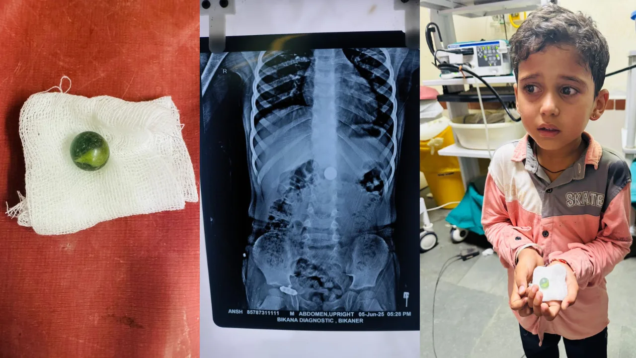 बच्चे ने कांच की गोली निगली है तो जानें खतरे, लक्षण और इलाज के सुरक्षित उपाय