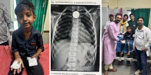 बच्चे ने सिक्का निगला: लक्षण, X-ray निदान और Endoscopy द्वारा इलाज