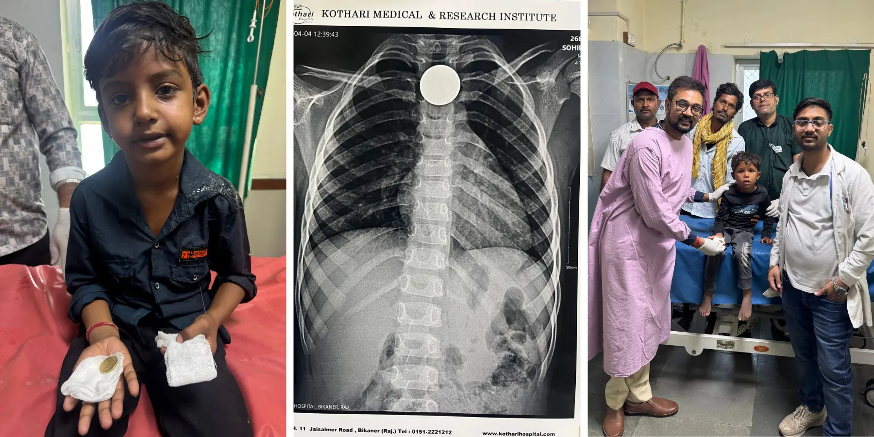 बच्चे ने सिक्का निगला case – pediatric patient, chest X-ray में coin visible और डॉक्टर टीम के साथ recovery