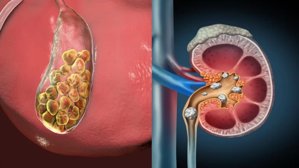 Gallstones vs kidney stones showing the difference in symptoms, causes and treatment
