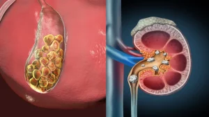 पथरी के लक्षण, कारण और इलाज: Gallstones vs Kidney Stones | Dr. Nikhil Gandhi