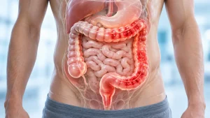 आंतों में सूजन के लक्षण: Colitis और IBD
